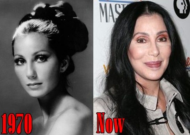 Cher Before and After Plastic Surgery Procedure
