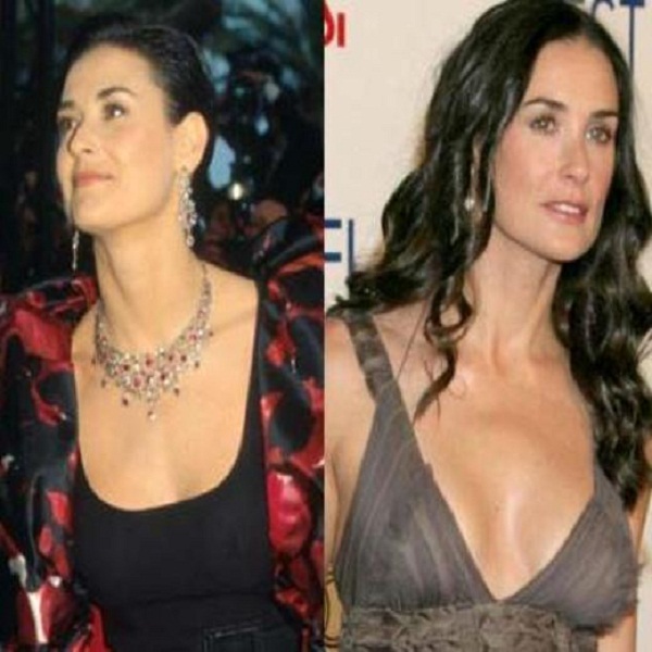 Demi Moore Breast Implants