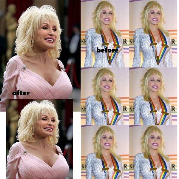 Dolly Parton Breast Implants Size Before & After