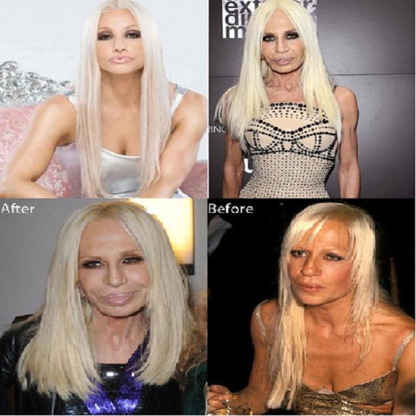 Donatella Versace Plastic Surgery Gone Wrong