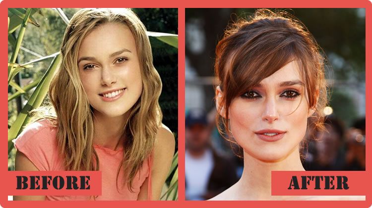 Keira Knightley Plastic Surgery Before & After Photos