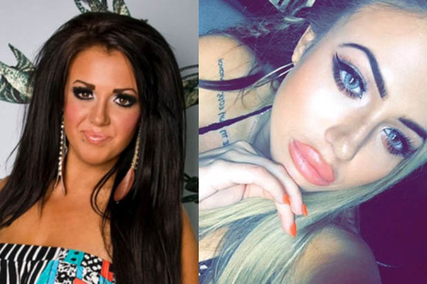 Holly Hagan before and after plastic surgery