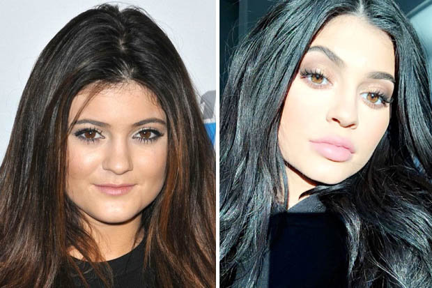 Kylie Jenner before and after lip fillers