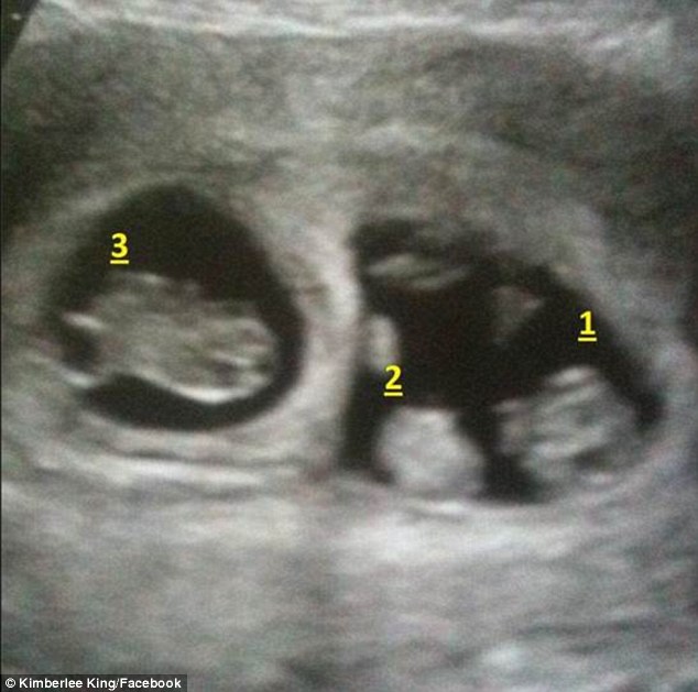 An ultrasound scan of Mrs King while she was pregnant with her her triplets, now aged four