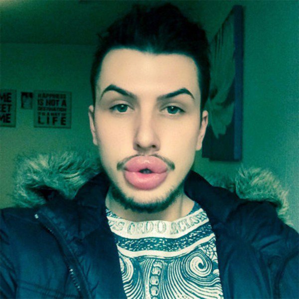 Surgery-obsessed lad spends more than £21,000 on cosmetic ops to look like the Kardashian sisters - including £10,000 on his lips alone