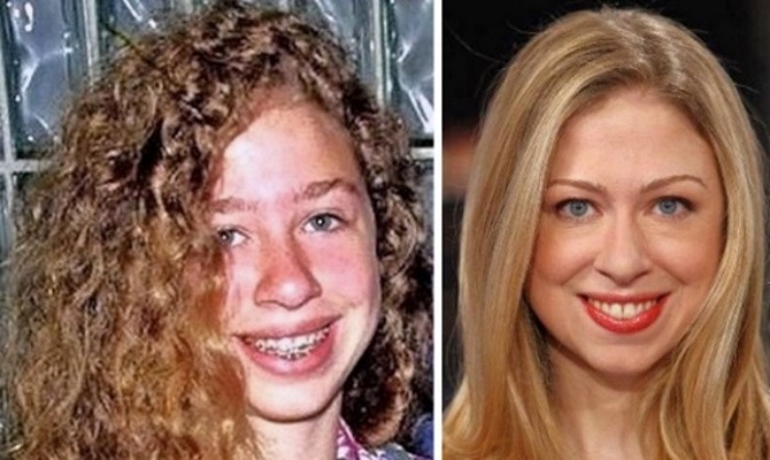chelsea clinton plastic surgery before after photos